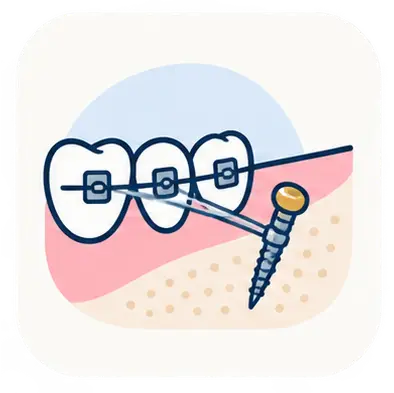 TCLE Ancoragem Esquelética (Mini-implantes)